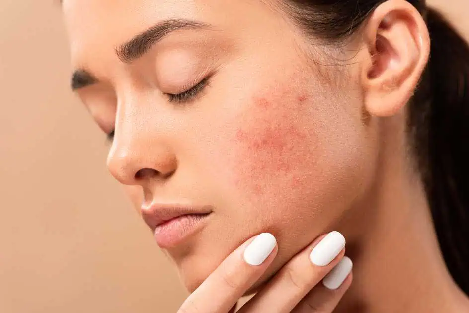 Acne Scars Treatment in East Greenwich, RI by Ocean State Laser and Aesthetics