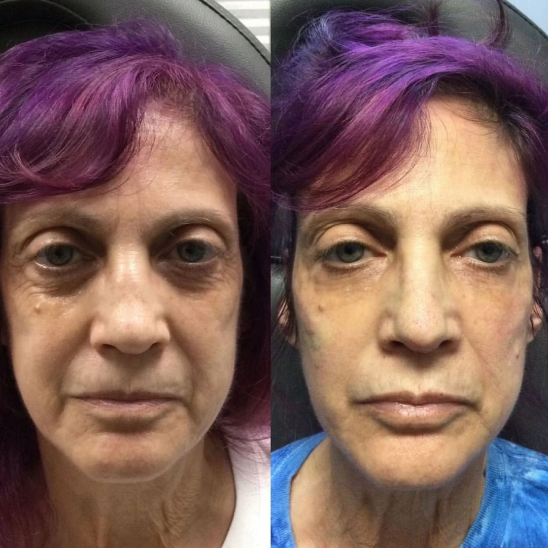 Filler B & A 2