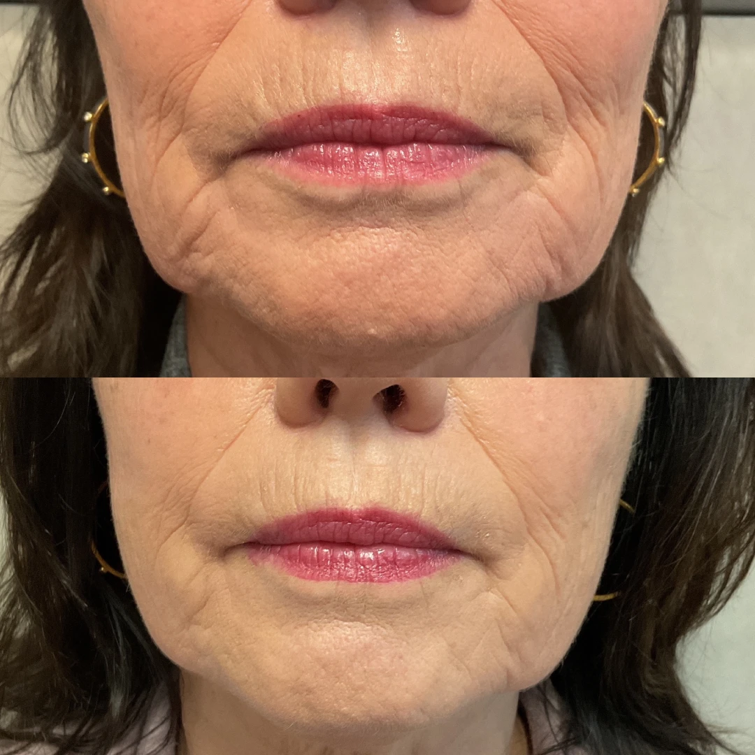 Fillers B & A 1