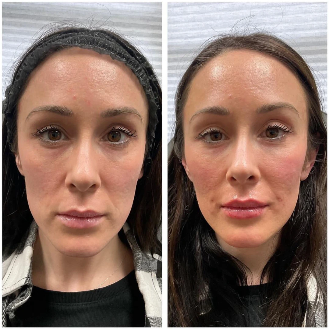 Fillers B & A 3