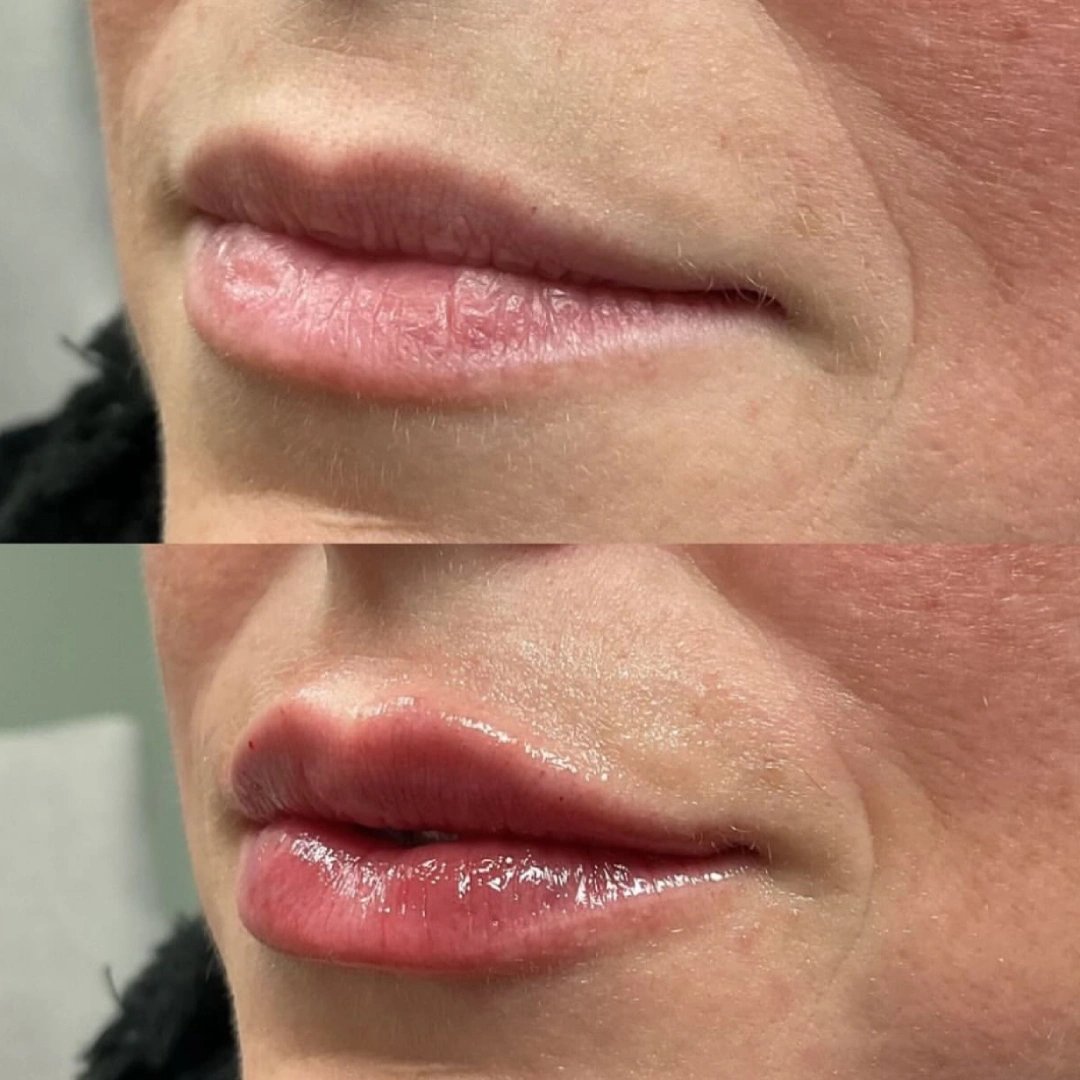 Lip Filler Before & After 1