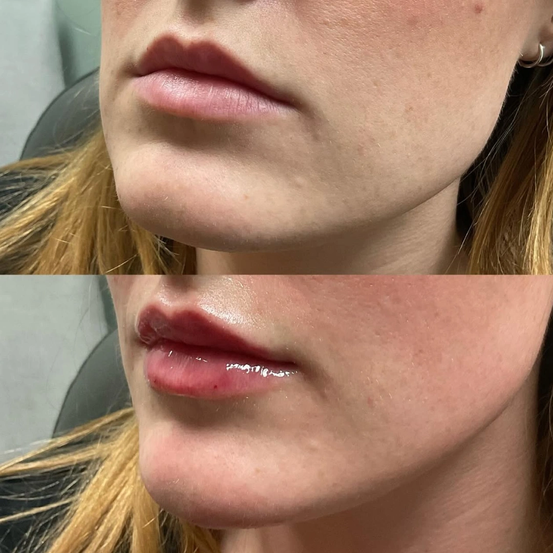 Lip Filler Before & After 2