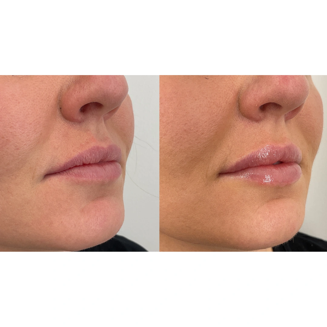 Lip Filler Before & After 3