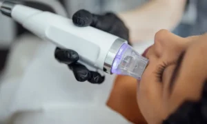 RF microneedling for skin rejuvenation